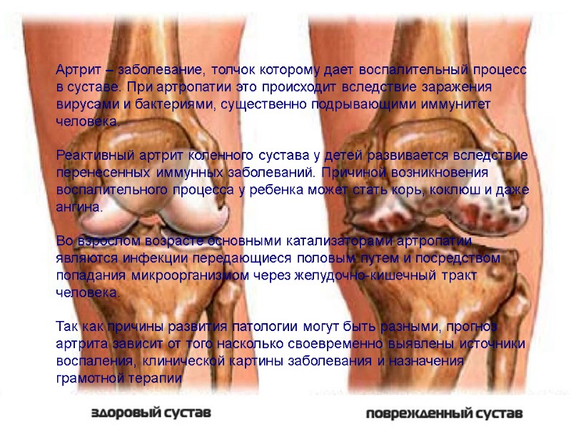 Артрит – заболевание, толчок которому дает воспалительный процесс в суставе. При артропатии это происходит
